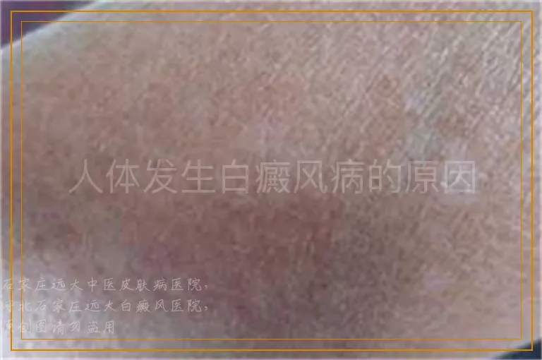 人体发生白癜风病的原因