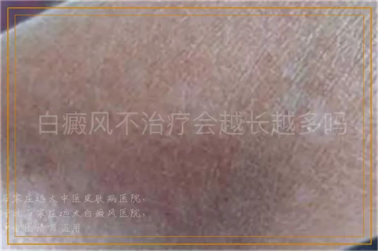 白癜风不治疗会越长越多吗