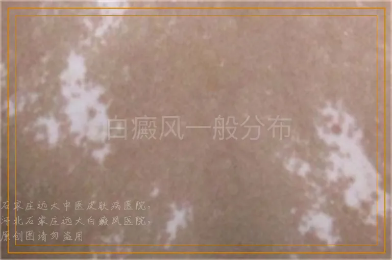 白癜风一般分布