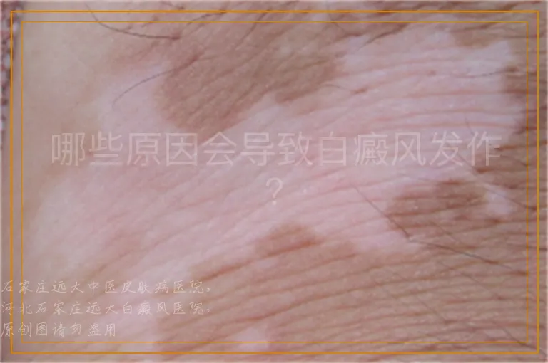 哪些原因会导致白癜风发作？