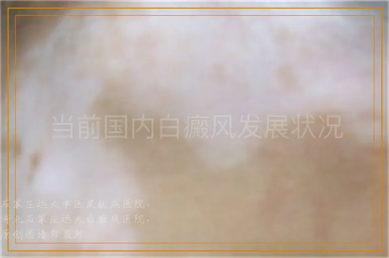 当前国内白癜风发展状况