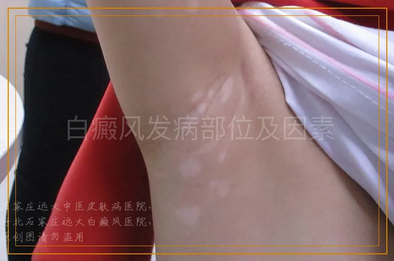 白癜风发病部位及因素