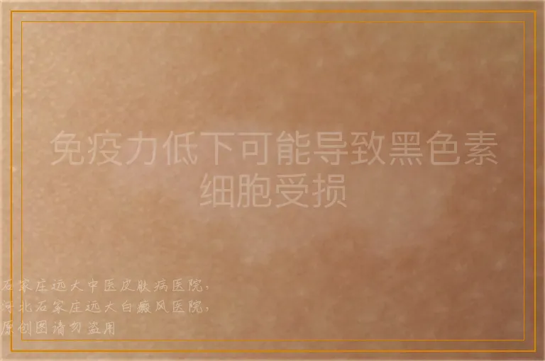免疫力低下可能导致黑色素细胞受损