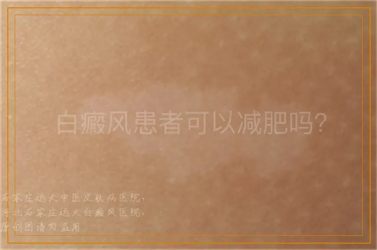 白癜风患者可以减肥吗？
