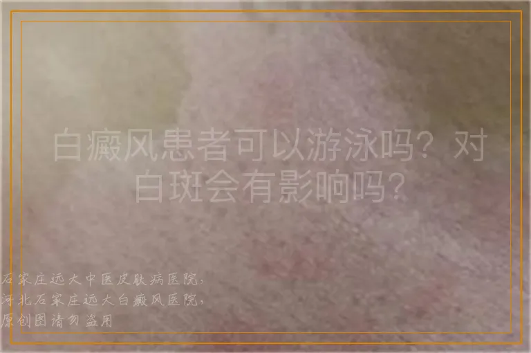 白癜风患者可以游泳吗？对白斑会有影响吗？