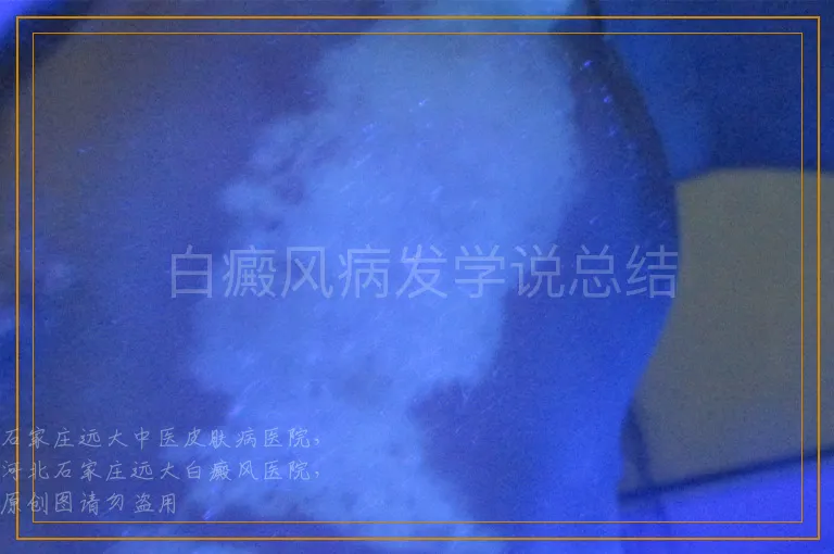 白癜风病发学说总结