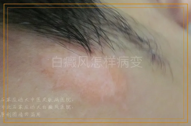 白癜风怎样病变