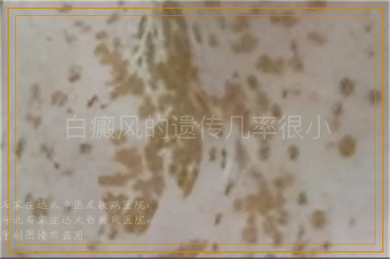 白癜风的遗传几率很小