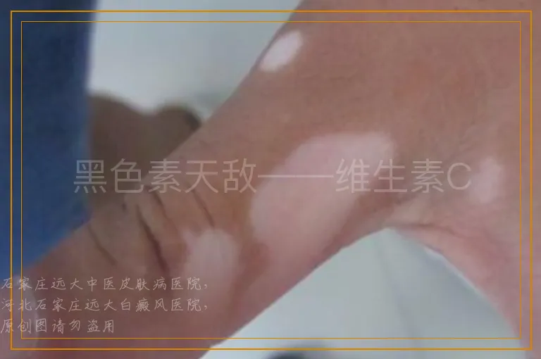 黑色素天敌——维生素C