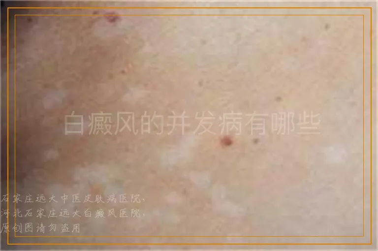 白癜风的并发病有哪些