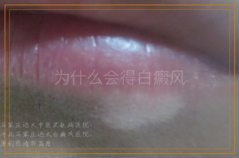 为什么会得白癜风
