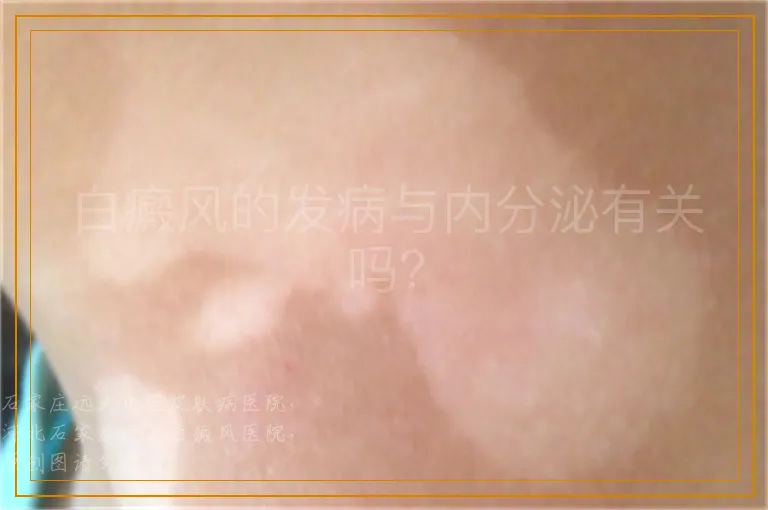 白癜风的发病与内分泌有关吗？