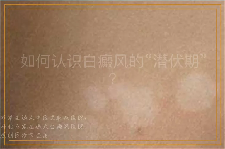 如何认识白癜风的“潜伏期”？