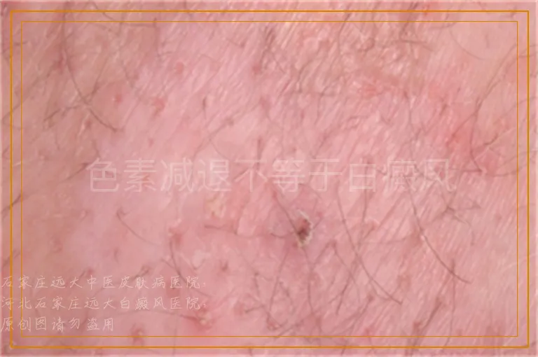 色素减退不等于白癜风