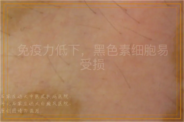 免疫力低下，黑色素细胞易受损