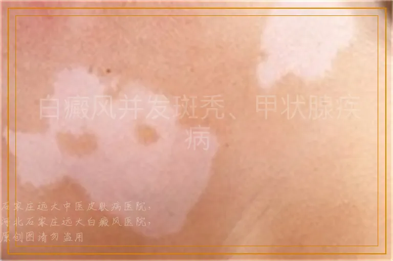白癜风并发斑秃、甲状腺疾病