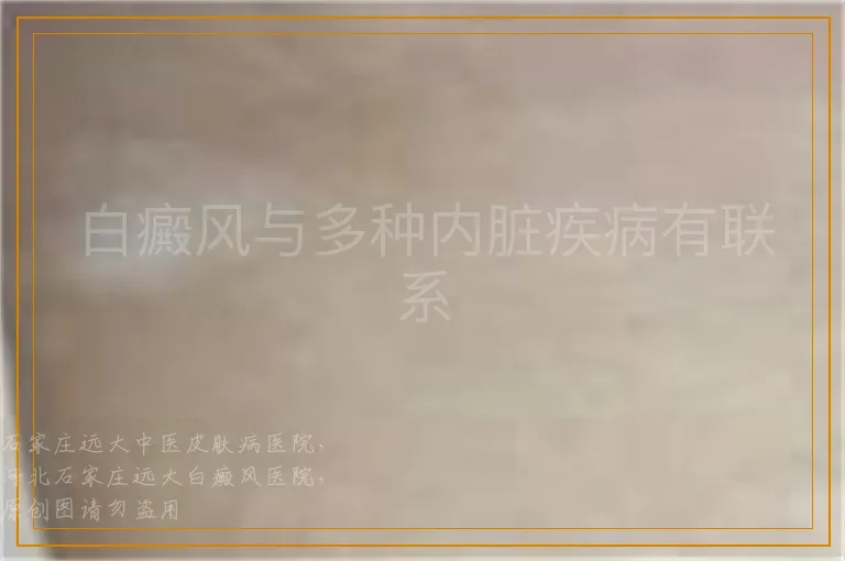 白癜风与多种内脏疾病有联系