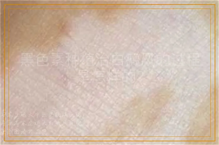 黑色素种植治白癜风的过程是怎样的？