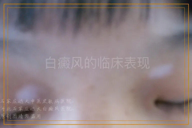 白癜风的临床表现