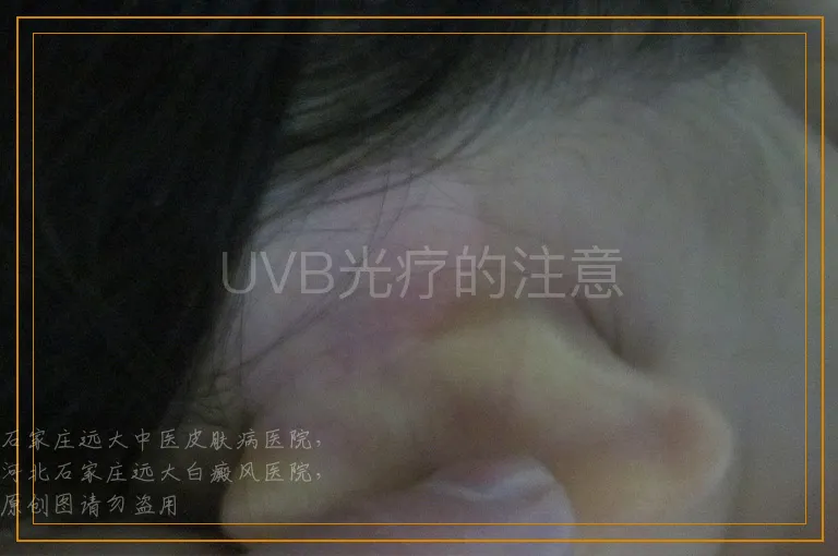 UVB光疗的注意