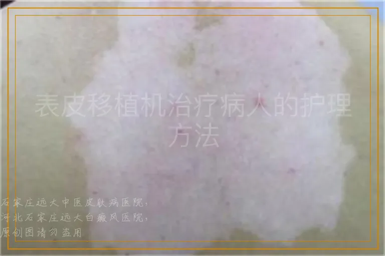 表皮移植机治疗病人的护理方法