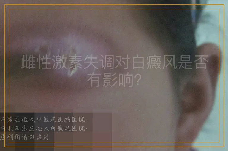 雌性激素失调对白癜风是否有影响?