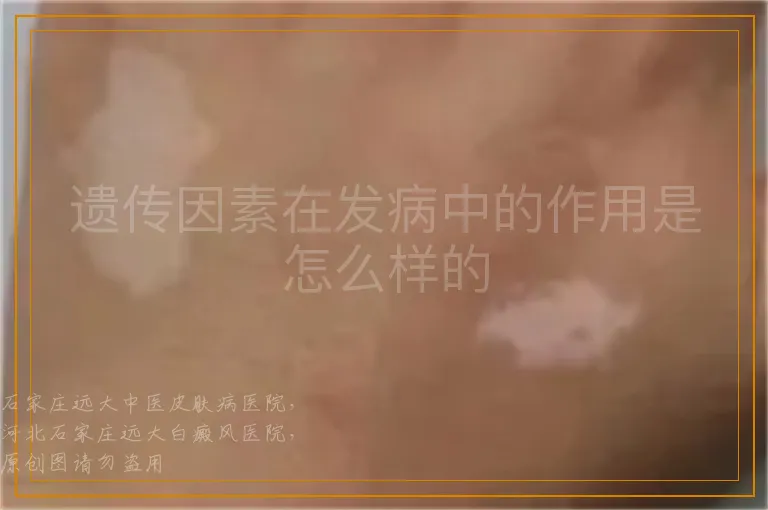 遗传因素在发病中的作用是怎么样的