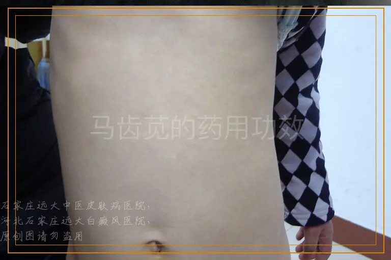 马齿苋的药用功效