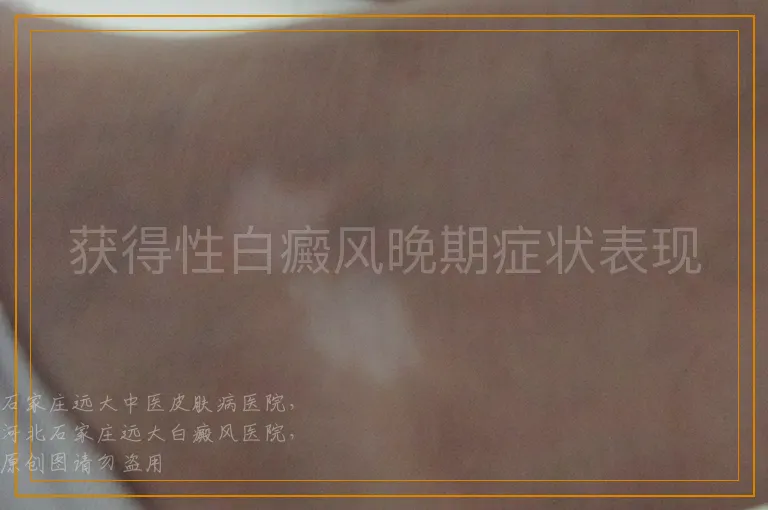 获得性白癜风晚期症状表现