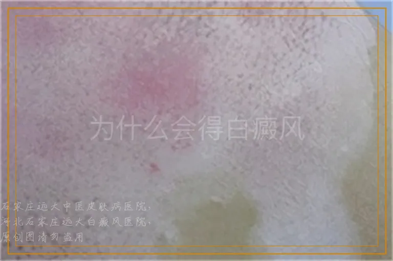 为什么会得白癜风