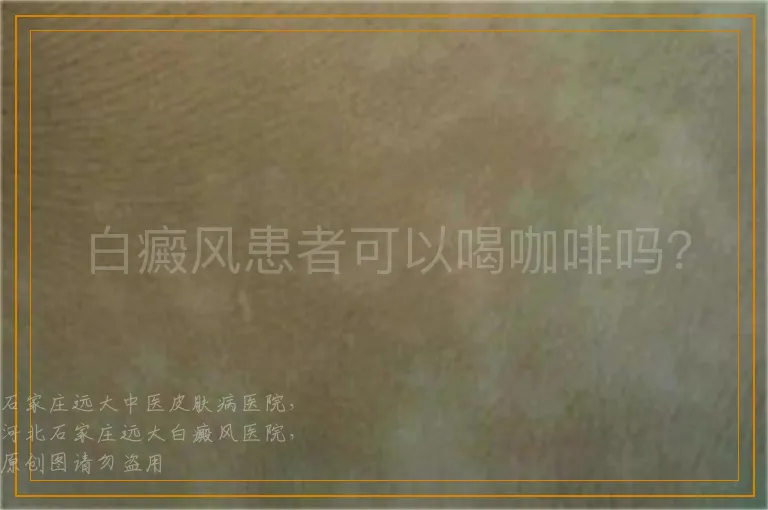 白癜风患者可以喝咖啡吗？