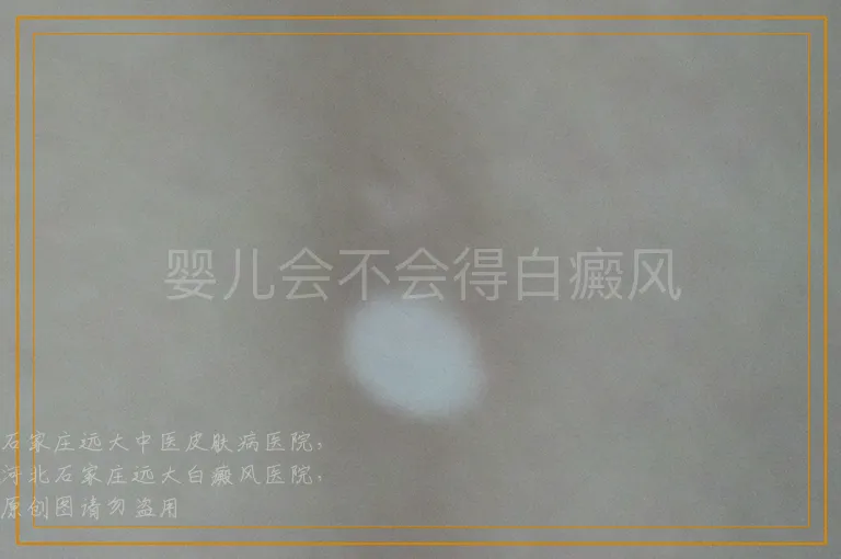 婴儿会不会得白癜风