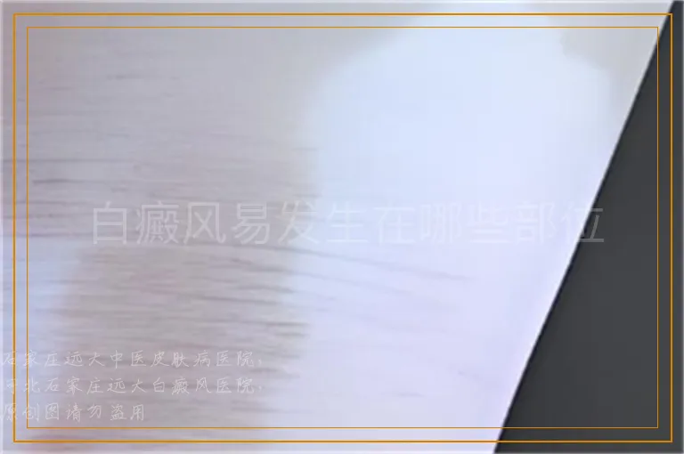 白癜风易发生在哪些部位