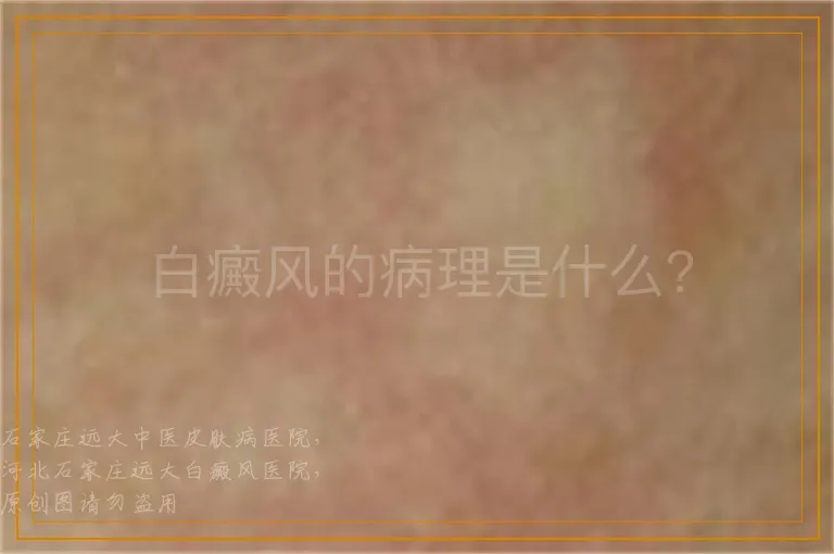 白癜风的病理是什么？
