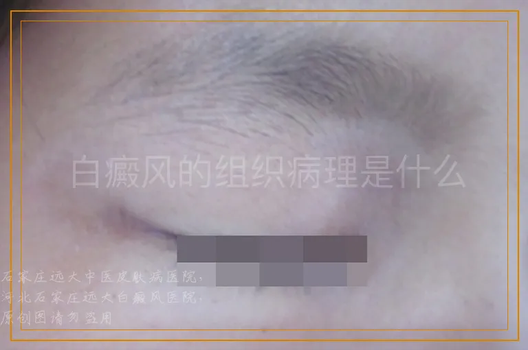 白癜风的组织病理是什么