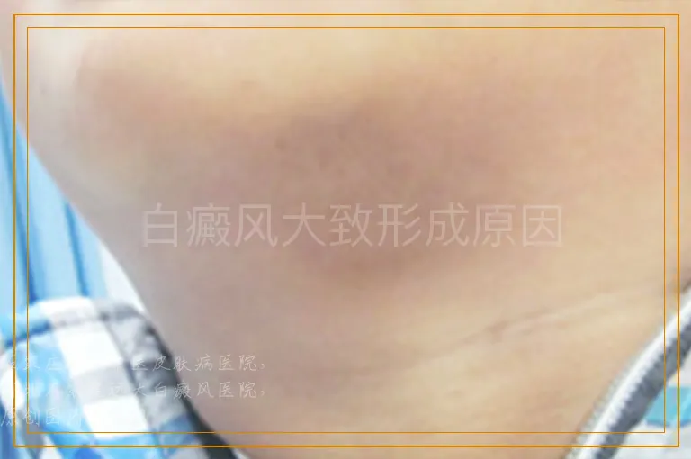 白癜风大致形成原因
