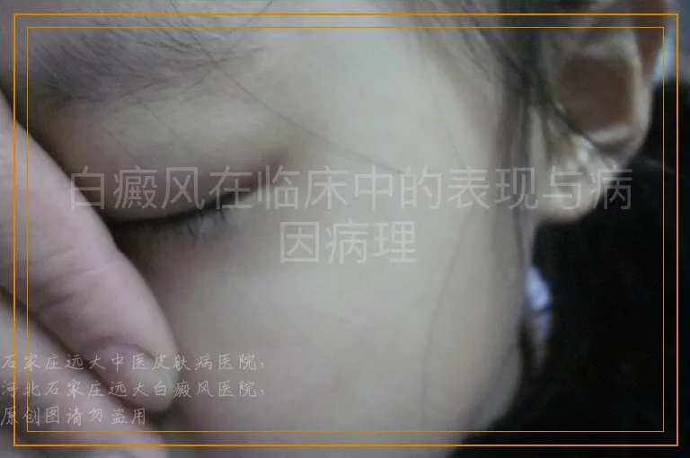 白癜风在临床中的表现与病因病理
