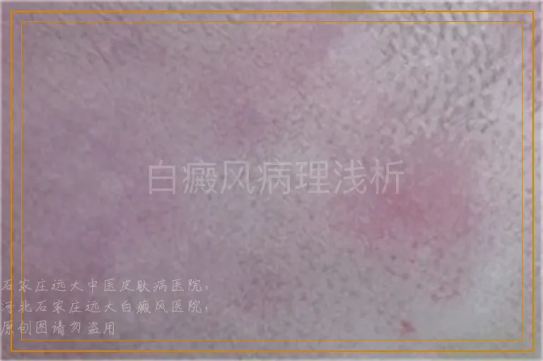 白癜风病理浅析
