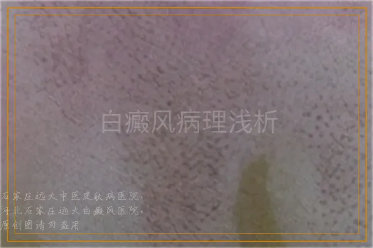 白癜风病理浅析