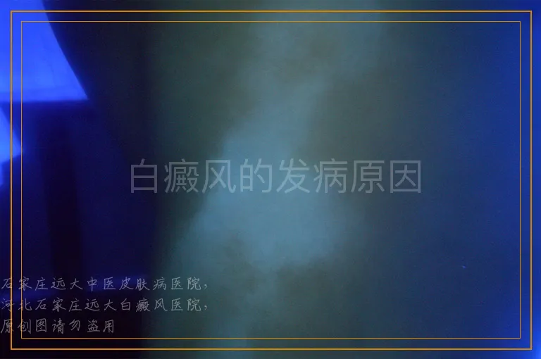 白癜风的发病原因