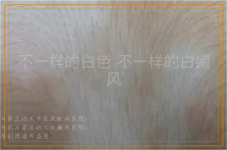 不一样的白色 不一样的白癜风