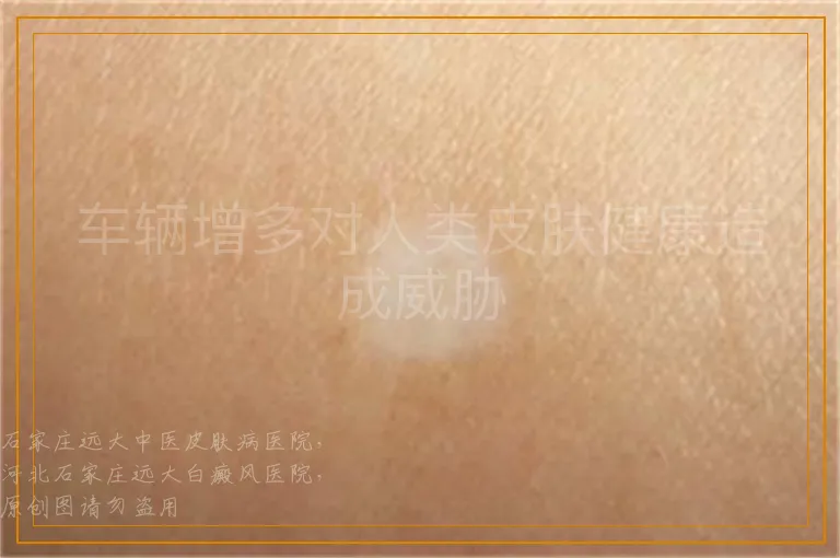 车辆增多对人类皮肤健康造成威胁