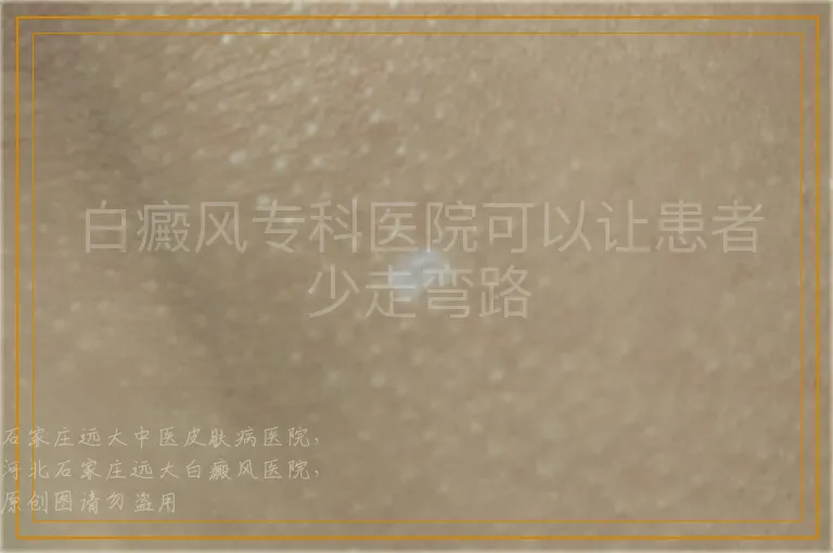 白癜风专科医院可以让患者少走弯路