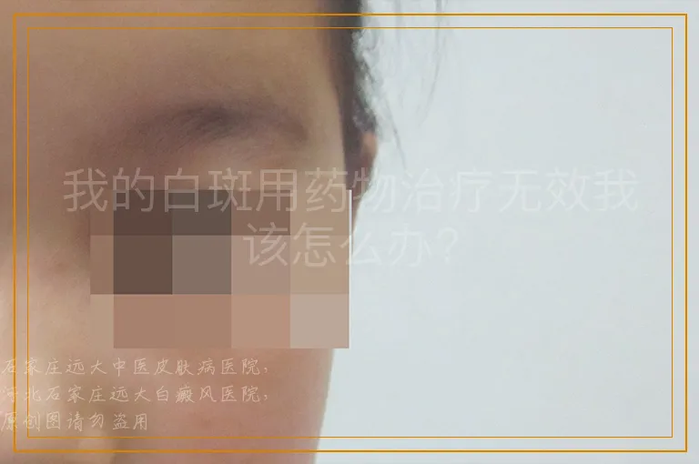 我的白斑用药物治疗无效我该怎么办?