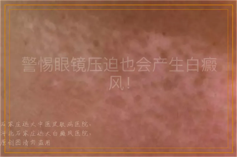警惕眼镜压迫也会产生白癜风！