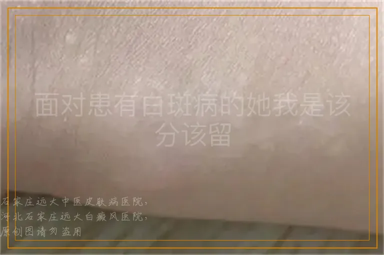 面对患有白斑病的她我是该分该留