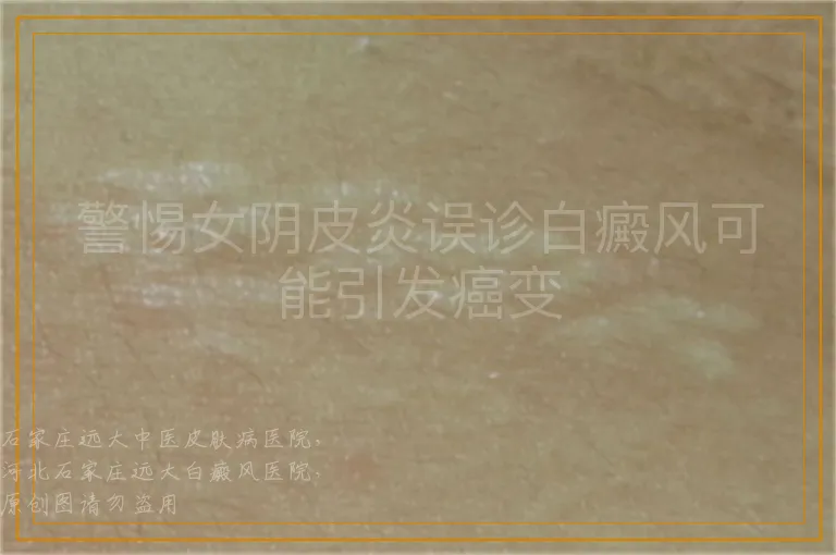 警惕女阴皮炎误诊白癜风可能引发癌变