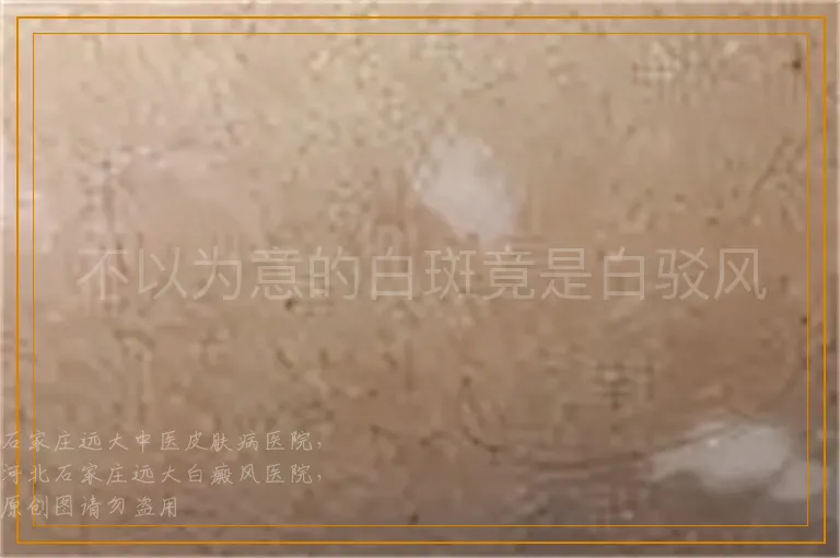 不以为意的白斑竟是白驳风