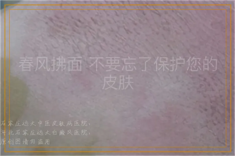 春风拂面 不要忘了保护您的皮肤