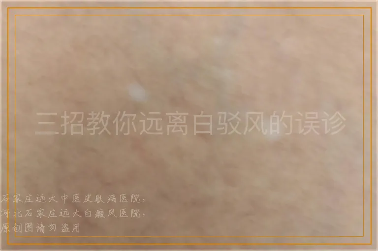 三招教你远离白驳风的误诊